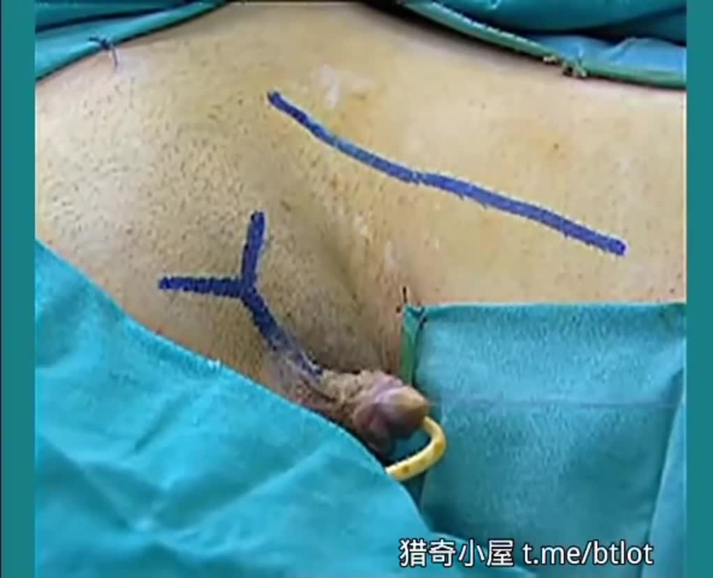 Плакат для 变形手术女变男栽了一个阴茎
